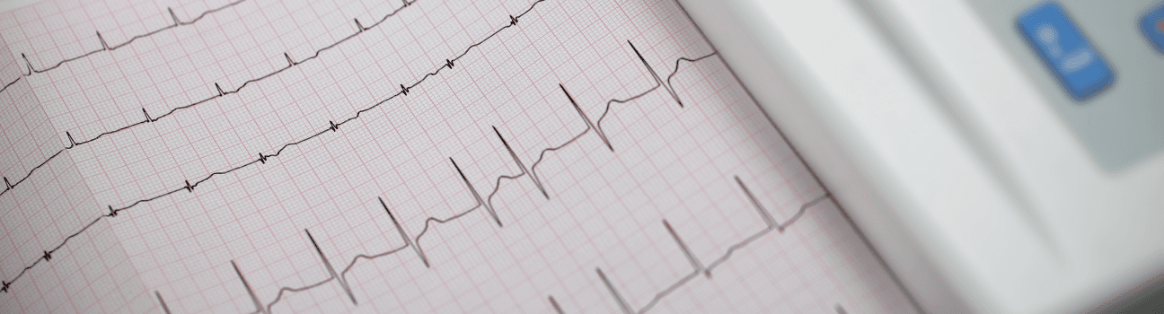 atrial fibrillation_1.png