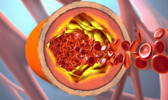 dyslipedimia (1).png
