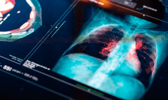 lung-cancer (1).png
