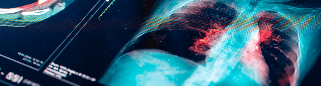 lung-cancer (2).png
